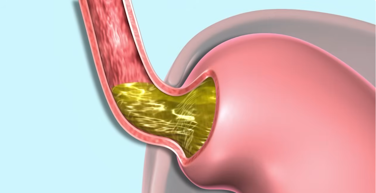 ارتجاع المرئ