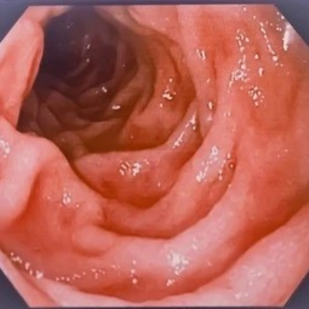 الكشف عن دوالي المرئ