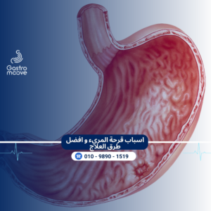 قرحة المريء و افضل طرق العلاج