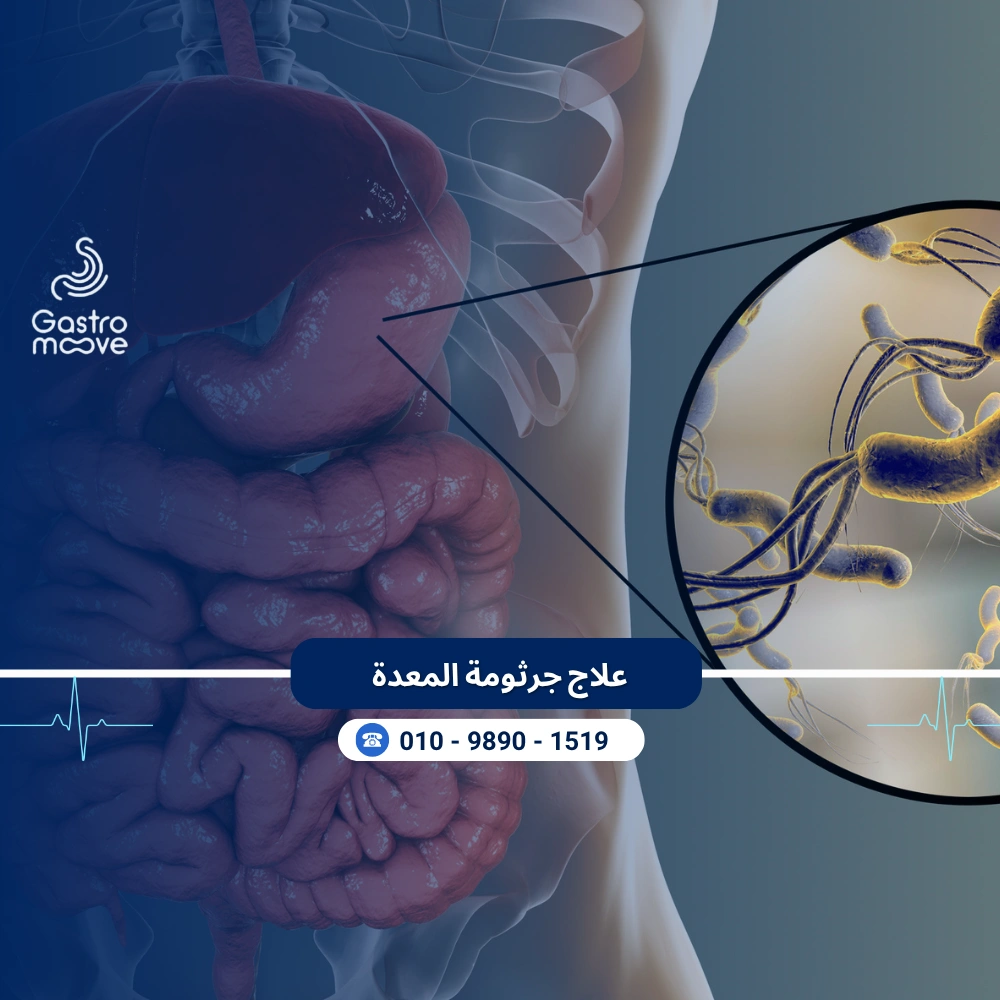 علاج جرثومة المعدة