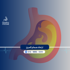 ارتخاء صمام المرئ