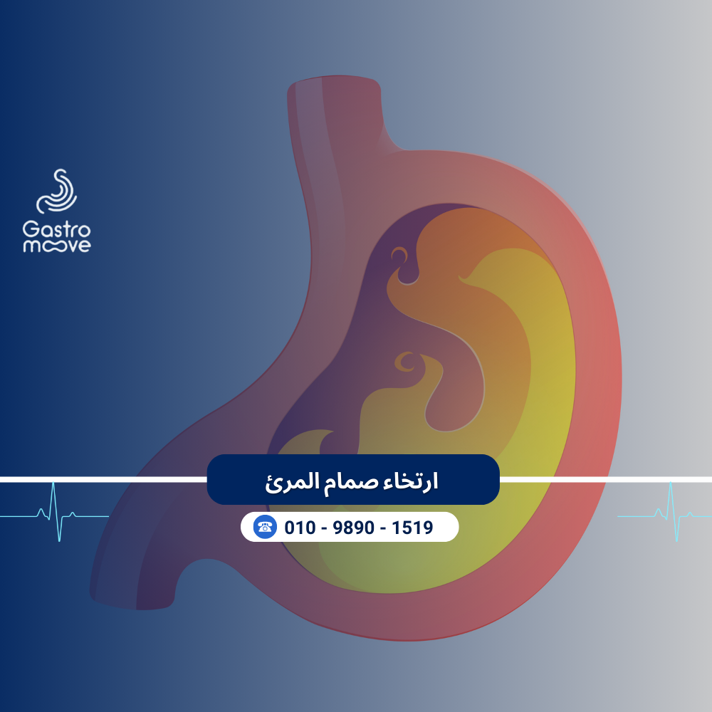 ارتخاء صمام المرئ