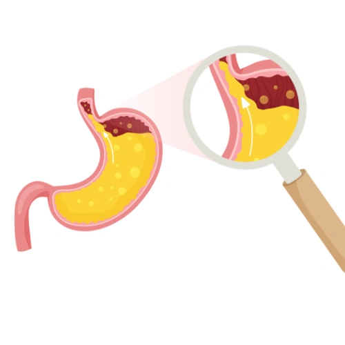 أسباب ارتخاء صمام المرئ