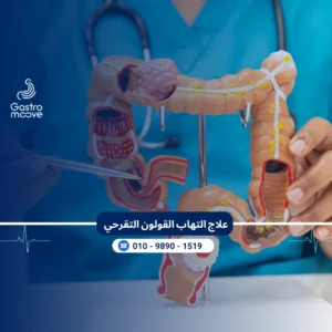 علاج القولون التقرحي