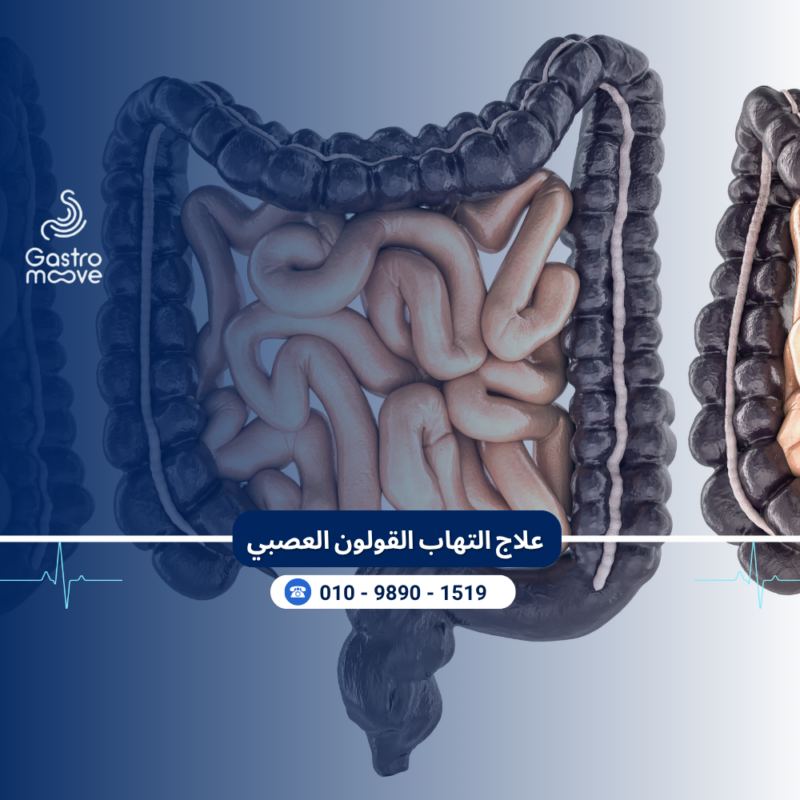 علاج القولون العصبي
