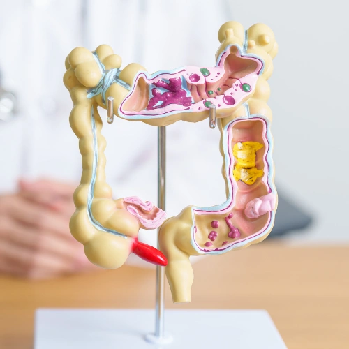 تعريف القولون التقرحي