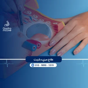 علاج مريء باريت