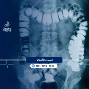 انسداد الأمعاء