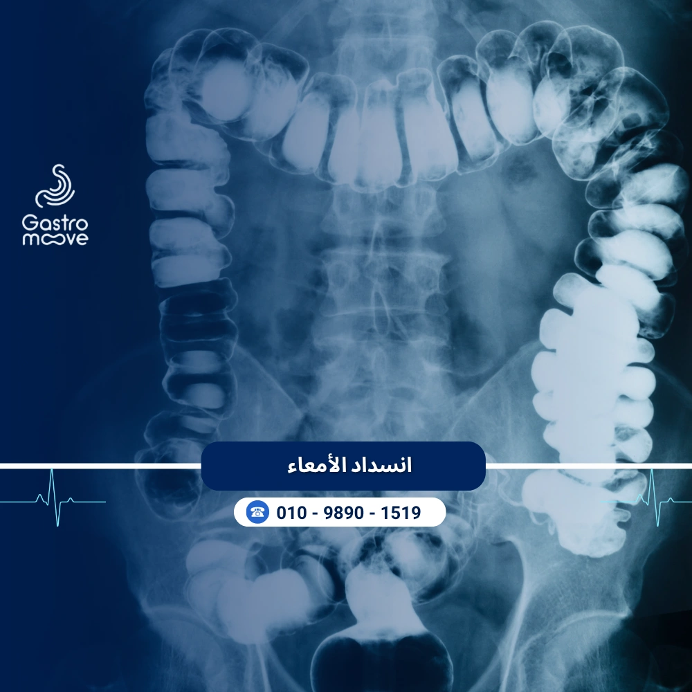 انسداد الأمعاء