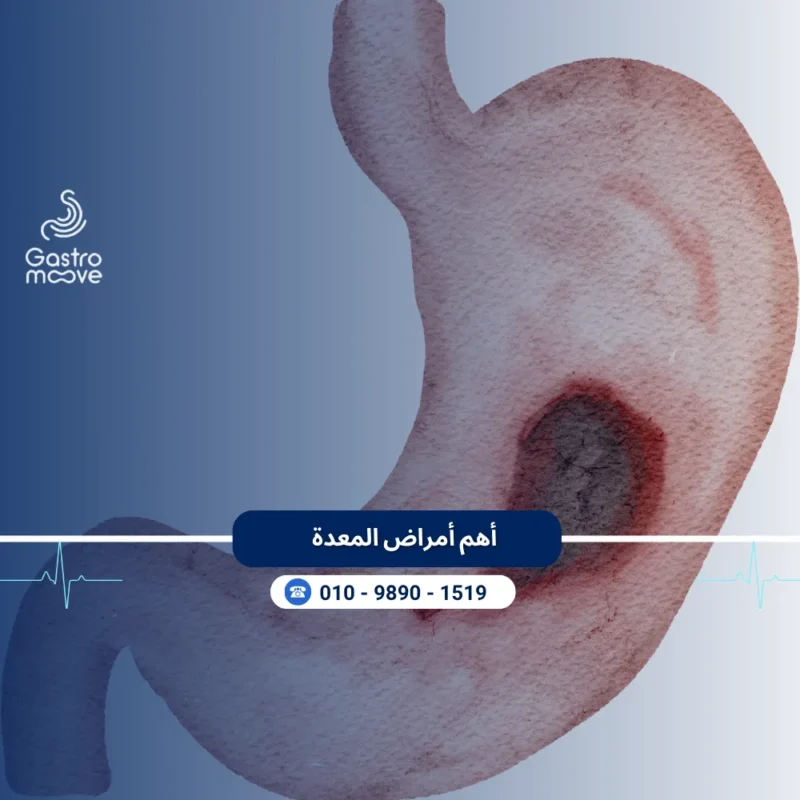 أهم أمراض المعدة