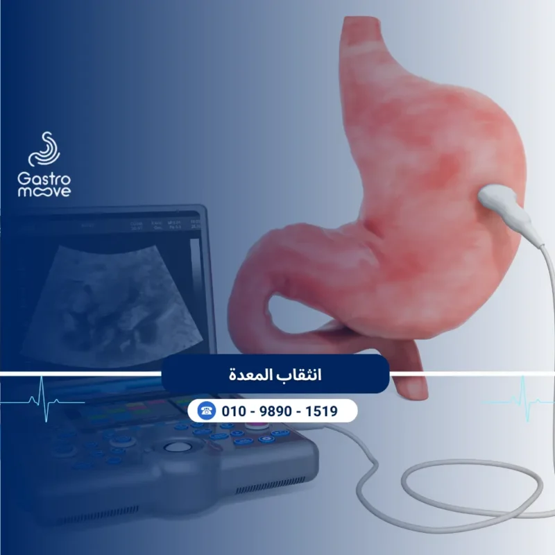 انثقاب المعدة
