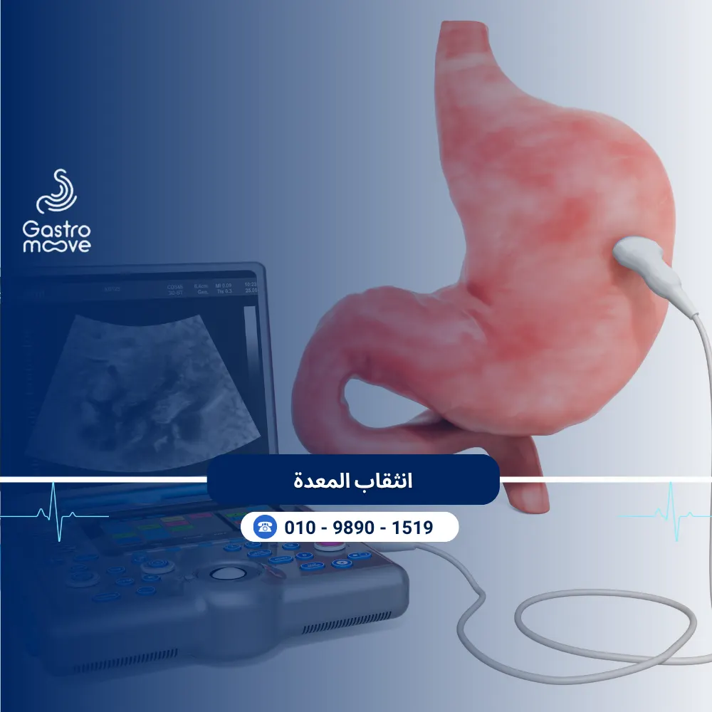 انثقاب المعدة